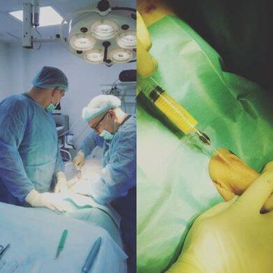 Zadebljanje penisa moguće je uz pomoć operacije