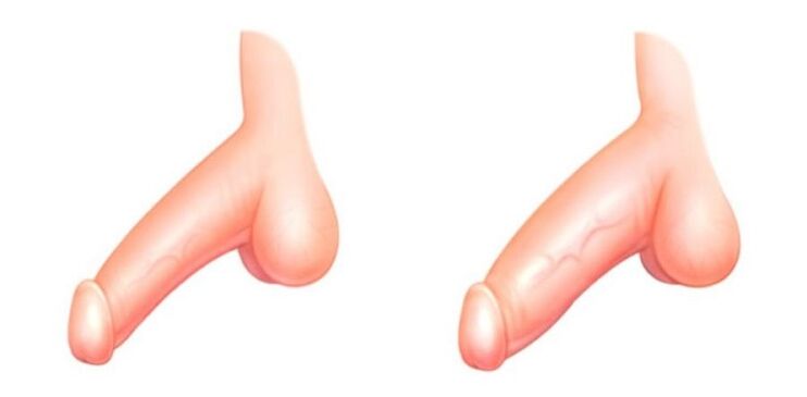 penis prije i poslije povećanja